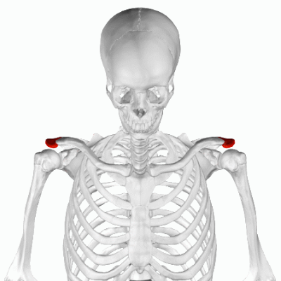 luxação da articulação acromioclavicular