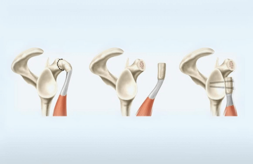 cirurgia para luxação do ombro